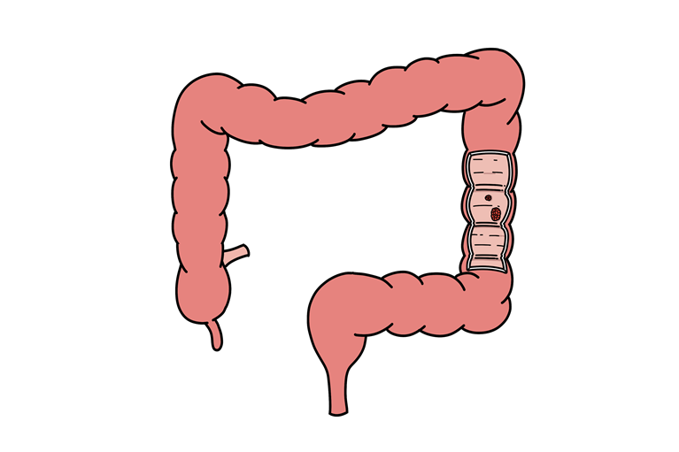 大腸がんについて