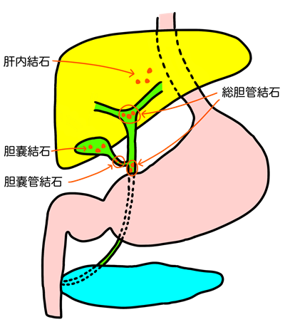 胆石は何ミリで危険？検診や腹部エコーで胆石があると言われた方へ
