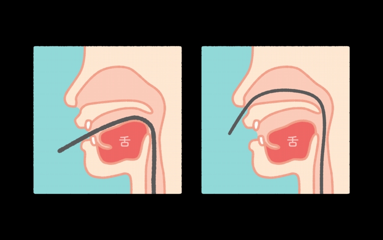 口から挿入する「経口内視鏡」、鼻から挿入する「経鼻内視鏡」