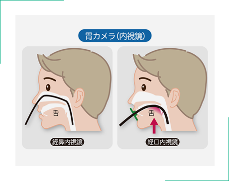 胃カメラ検査は経口用・経鼻用をご用意