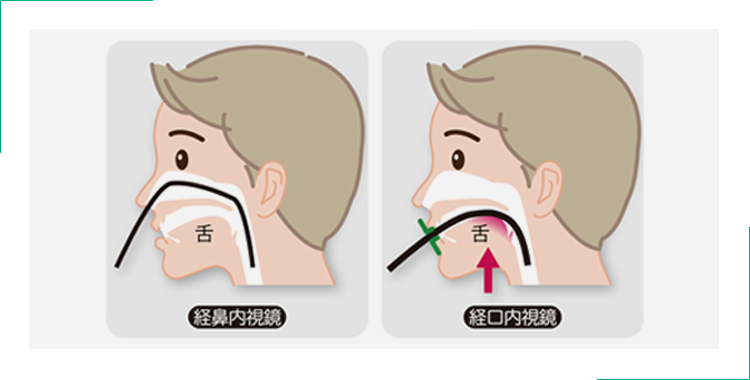 胃カメラ検査は経口用・経鼻用をご用意