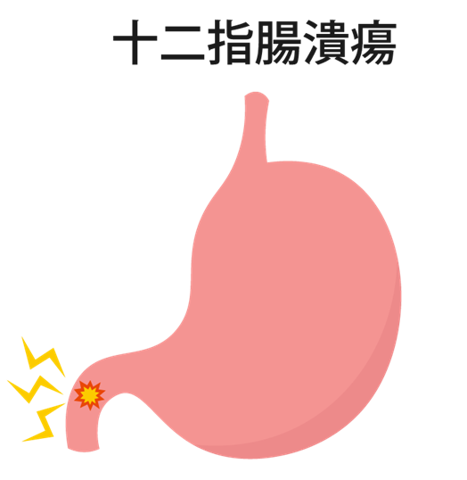 十二指腸潰瘍について